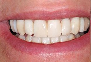 The image displays a person s smile with straight white teeth and a clean oral cavity, showcasing dental health and hygiene.