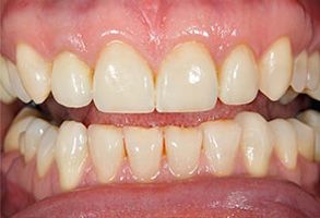 The image displays a close-up view of a person s teeth with a focus on an upper front tooth showing signs of decay, discoloration, and staining.