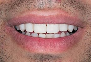 The image shows a close-up of a person s mouth with teeth, featuring a smile and a dimple on one side.