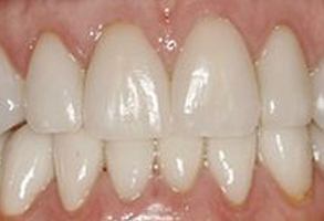 The image shows a close-up view of a person s teeth with a focus on the lower front teeth, which appear to be yellowed and possibly stained, suggesting the need for dental care or cosmetic treatment.