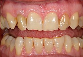 The image shows a close-up view of a person s teeth with yellowing and staining, indicating poor oral hygiene.